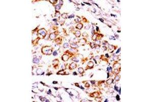 Formalin-fixed and paraffin-embedded human cancer tissue reacted with the primary antibody, which was peroxidase-conjugated to the secondary antibody, followed by DAB staining. (NME3 Antikörper  (AA 59-88))