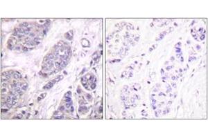 Immunohistochemistry analysis of paraffin-embedded human breast carcinoma tissue, using TGF beta3 Antibody. (TGFB3 Antikörper  (AA 261-310))