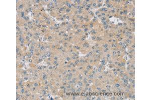 Immunohistochemistry of Human liver cancer using SMOC2 Polyclonal Antibody at dilution of 1:30