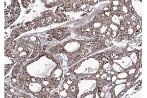IHC-P Image Immunohistochemical analysis of paraffin-embedded gastric cancer N87 xenograft, using AK3L1, antibody at 1:100 dilution.