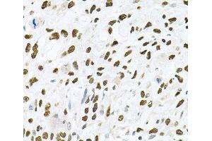 Immunohistochemistry of paraffin-embedded Human lung cancer using JNK1 Polyclonal Antibody at dilution of 1:100 (40x lens). (JNK Antikörper)