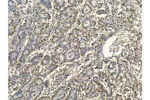 MCM2 Mouse Monoclonal Antibody at 1/100 staining human colorectal cancer by IHC-P. (MCM2 Antikörper)