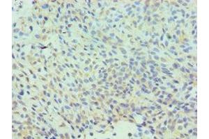Immunohistochemistry of paraffin-embedded human breast cancer using ABIN7147585 at dilution of 1:100 (CLIC1 Antikörper  (AA 42-241))