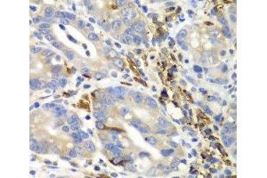 Immunohistochemistry of paraffin-embedded Human gastric cancer using AIMP1 Polyclonal Antibody at dilution of 1:100 (40x lens). (AIMP1 Antikörper)