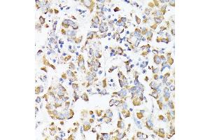 Immunohistochemistry of paraffin-embedded human liver cancer using RHOG antibody (ABIN7269864) at dilution of 1:100 (40x lens). (RHOG Antikörper)