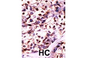 Formalin-fixed and paraffin-embedded human cancer tissue reacted with UCK2 polyclonal antibody  , which was peroxidase-conjugated to the secondary antibody, followed by DAB staining. (UCK2 Antikörper  (N-Term))