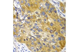 Immunohistochemistry of paraffin-embedded human esophageal cancer using AK1 antibody.