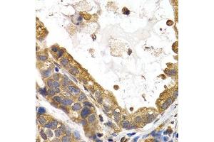 Immunohistochemistry of paraffin-embedded human stomach cancer using GYS1 antibody. (Glycogen Synthase 1 Antikörper  (AA 488-737))
