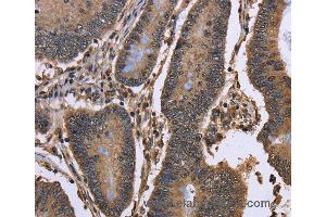 Immunohistochemistry of Human colon cancer using DCP1A Polyclonal Antibody at dilution of 1:50 (DCP1A Antikörper)