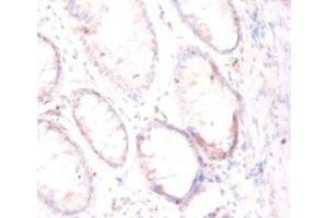 Immunohistochemistry of paraffin-embedded human colon cancer using ABIN7153948 at dilution of 1:50 (PSMA Antikörper  (AA 48-750))