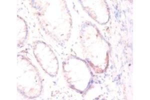 Immunohistochemistry of paraffin-embedded human colon cancer using ABIN7153948 at dilution of 1:50 (PSMA Antikörper  (AA 48-750))