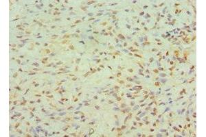 Immunohistochemistry of paraffin-embedded human breast cancer using ABIN7145557 at dilution of 1:100 (JMJD6 Antikörper  (AA 1-320))