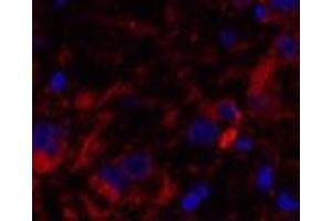 Immunofluorescence analysis of Human breast cancer tissue using Cleaved-CASP8 (D384) Polyclonal Antibody at dilution of 1:200. (Caspase 8 Antikörper  (Cleaved-Asp384))