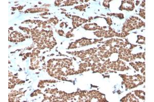 Formalin-fixed, paraffin-embedded human Breast Carcinoma stained with Histone H1 Rabbit Recombinant Monoclonal Antibody (AE-4).