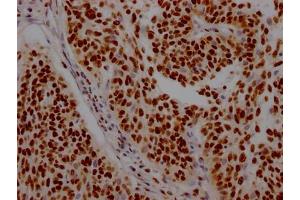 IHC image of ABIN7127571 diluted at 1:100 and staining in paraffin-embedded human cervical cancer performed on a Leica BondTM system. (Rekombinanter Interleukin enhancer-binding factor 3 (ILF3) Antikörper)