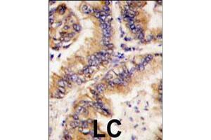 Formalin-fixed and paraffin-embedded human lung carcinoma tissue reacted with TRAPPC4 polyclonal antibody  , which was peroxidase-conjugated to the secondary antibody, followed by DAB staining. (TRAPPC4 Antikörper  (N-Term))