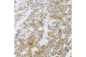 Immunohistochemistry of paraffin-embedded human liver cancer using AIFM3 antibody (ABIN5996156) at dilution of 1/100 (40x lens). (AIFM3 Antikörper)