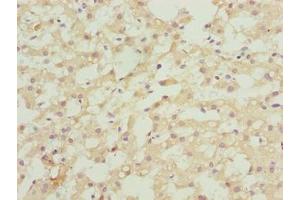 Immunohistochemistry of paraffin-embedded human liver cancer using ABIN7144572 at dilution of 1:100 (ASAP3 Antikörper  (AA 451-700))