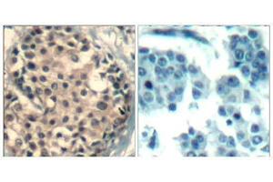 Immunohistochemical analysis of paraffin-embedded human breast carcinoma tissue using HDAC4/HDAC5/ HDAC9 (phospho-Ser246/259/220) Antibody (E011517). (HDAC4/HDAC5/HDAC9 Antikörper  (pSer220, pSer246, pSer259))