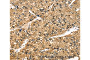 Immunohistochemistry of Human breast cancer using STX8 Polyclonal Antibody at dilution of 1:45