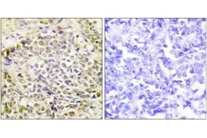 Immunohistochemistry analysis of paraffin-embedded human lung carcinoma tissue, using IRX2 Antibody. (IRX2 Antikörper  (AA 231-280))
