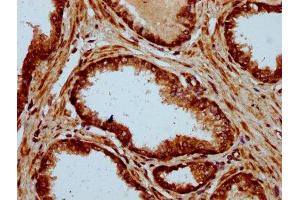 IHC image of ABIN7150052 diluted at 1:500 and staining in paraffin-embedded human prostate cancer performed on a Leica BondTM system. (ADAM29 Antikörper  (AA 701-820))