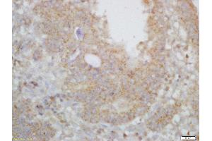 Formalin-fixed and paraffin embedded human gastric carcinoma labeled with Rabbit Anti-ARPC2/p34-ARC Polyclonal Antibody, Unconjugated  at 1:200 followed by conjugation to the secondary antibody and DAB staining (ARPC2 Antikörper  (AA 201-300))