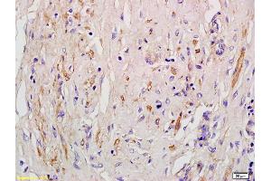 Formalin-fixed and paraffin embedded human pneumonic lung tissue labeled with Anti-EDG4/LPA2 Polyclonal Antibody, Unconjugated (ABIN681118) at 1:200 followed by conjugation to the secondary antibody and DAB staining (Angiotensin II Type-1 Receptor Antikörper)