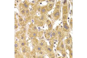 Immunohistochemistry of paraffin-embedded human liver damage using Slug Antibody (ABIN6127298, ABIN6148181, ABIN6148183 and ABIN6217314) at dilution of 1:100 (40x lens). (SLUG Antikörper  (AA 126-268))