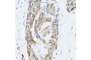 Immunohistochemistry of paraffin-embedded human esophageal cancer using TOLLIP antibody (ABIN5971228) at dilution of 1/100 (40x lens).