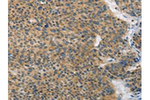 The image on the left is immunohistochemistry of paraffin-embedded Human liver cancer tissue using ABIN7128398(ANAPC13 Antibody) at dilution 1/25, on the right is treated with fusion protein. (ANAPC13 Antikörper)