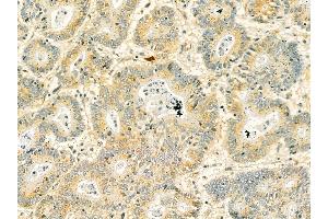 SPTBN1 Mouse Monoclonal Antibody at 1/100 staining human colorectal cancer by IHC-P. (SPTBN1 Antikörper  (N-Term))