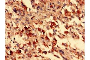 Immunohistochemistry analysis of human melanoma using ABIN7153105 at dilution of 1:100 (FOXR2 Antikörper  (AA 1-300))