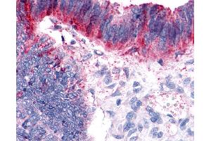 Anti-GPER1 / GPR30 antibody IHC of human Colon, Carcinoma. (GPER Antikörper  (Extracellular Domain))