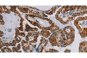 Immunohistochemistry of paraffin-embedded Human thyroid cancer using NDUFS3 Polyclonal Antibody at dilution of 1:30 (NDUFS3 Antikörper)