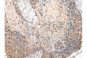 The image on the left is immunohistochemistry of paraffin-embedded Human esophagus cancer tissue using ABIN7131583(VPS37A Antibody) at dilution 1/20, on the right is treated with fusion protein. (VPS37A Antikörper)