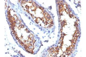 Formalin-fixed, paraffin-embedded human Testicular Carcinoma stained with CD99 Mouse Monoclonal Antibody (HO36-1.