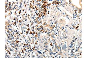 The image on the left is immunohistochemistry of paraffin-embedded Human gastric cancer tissue using ABIN7190149(CD93 Antibody) at dilution 1/60, on the right is treated with synthetic peptide. (CD93 Antikörper)