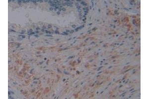 Detection of FAPa in Human Prostate Tissue using Polyclonal Antibody to Fibroblast Activation Protein Alpha (FAPa) (FAP Antikörper  (AA 523-760))