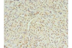 Immunohistochemistry of paraffin-embedded human breast cancer using ABIN7169003 at dilution of 1:100 (STK38L Antikörper  (AA 212-464))