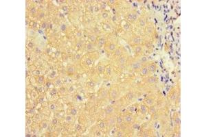Immunohistochemistry of paraffin-embedded human liver cancer using ABIN7144419 at dilution of 1:100 (APOC3 Antikörper  (AA 21-99))