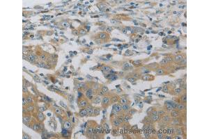 Immunohistochemistry of Human breast cancer using MAP2K6 Polyclonal Antibody at dilution of 1:30 (MAP2K6 Antikörper)