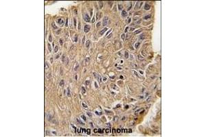 Formalin-fixed and paraffin-embedded human lung carcinoma tissue reacted with ANTXR1 Antibody  (ABIN392154 and ABIN2841879) , which was peroxidase-conjugated to the secondary antibody, followed by DAB staining. (ANTXR1 Antikörper  (AA 358-386))