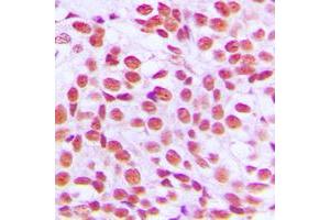 Immunohistochemical analysis of EGR1 staining in human breast cancer formalin fixed paraffin embedded tissue section. (EGR1 + EGR2 (C-Term) Antikörper)