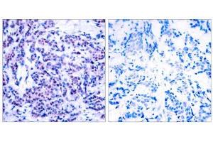 Immunohistochemical analysis of paraffin-embedded human breast carcinoma tissue using JunD (phospho- Ser255) antibody (E011028). (JunD Antikörper  (pSer255))