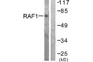 Immunohistochemistry analysis of paraffin-embedded human lung carcinoma tissue using Raf1 (Ab-621) antibody. (RAF1 Antikörper  (Ser621))