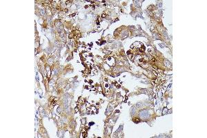 Immunohistochemistry of paraffin-embedded human lung cancer using CD52 antibody (ABIN7266207) at dilution of 1:100 (40x lens). (CD52 Antikörper  (AA 1-61))
