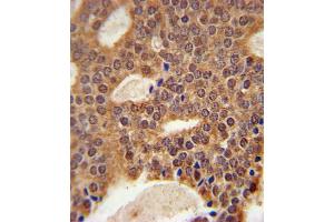 DCLRE1B Antibody (Center) (ABIN651618 and ABIN2840328) immunohistochemistry analysis in formalin fixed and paraffin embedded human prostate carcinoma followed by peroxidase conjugation of the secondary antibody and DAB staining. (DCLRE1B Antikörper  (AA 208-236))