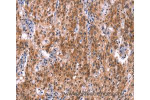 Immunohistochemistry of Human gastric cancer using GH1 Polyclonal Antibody at dilution of 1:40 (Growth Hormone 1 Antikörper)