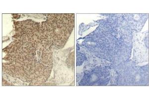 Immunohistochemical analysis of paraffin-embedded human breast carcinoma tissue using HDAC2(Phospho-Ser394) Antibody(left) or the same antibody preincubated with blocking peptide(right).